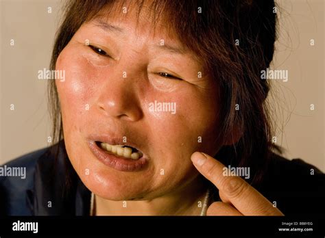 Wang Ying, 22, has had plastic surgery with Ao Mei Ding that has disfigured her face Stock Photo ...