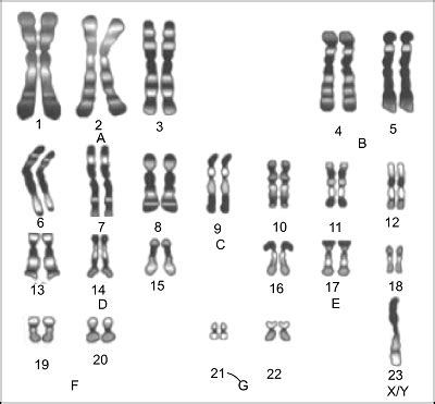 Describe an individual with the karyotype shown. A. a female with ...