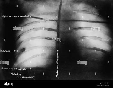 Theodore Roosevelt's chest x-ray after John F. Schrank's attempted ...