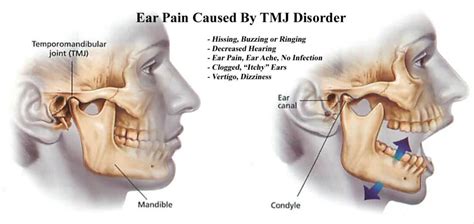 Ear Pain & Ringing | Head Pain Institute