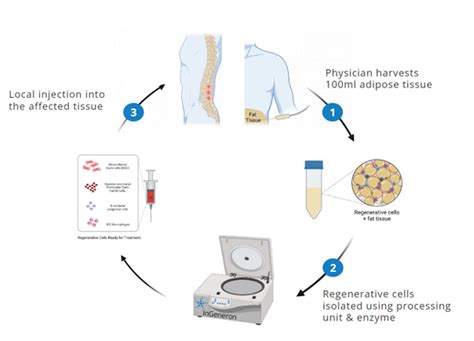 JPM | Free Full-Text | Safety and Efficacy of Autologous Stem Cell Treatment for Facetogenic ...