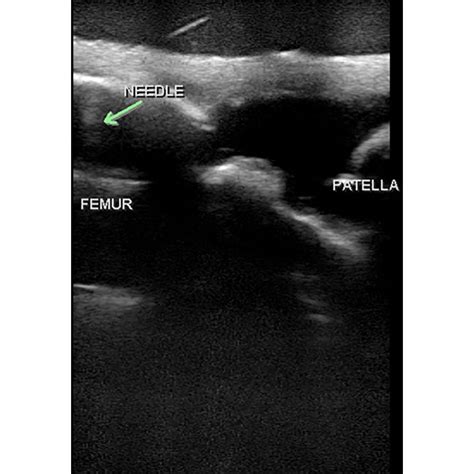 MSK Knee Ultrasound Training Model