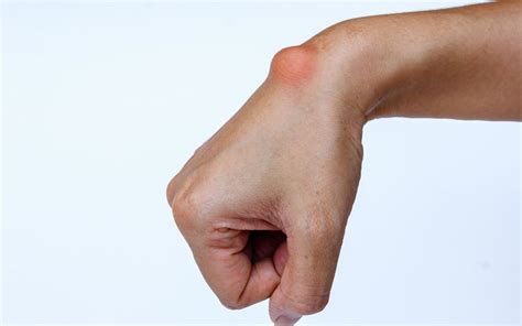 Ganglion cysts | Melbourne Hand Therapy