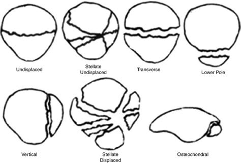 1 Descriptive classification of patellar fractures | Download Scientific Diagram