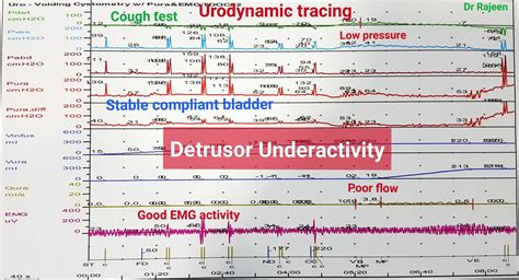 Urodynamics / Urodynamic Study - Urology Malaysia