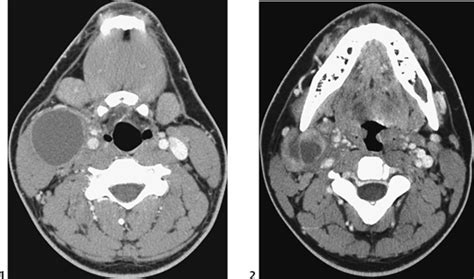 23 Branchial Cleft Cyst | Radiology Key