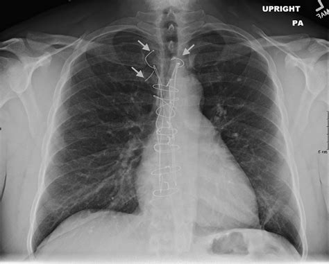 Sternal Fracture X Ray