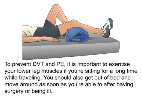 Exercises To Prevent Dvts