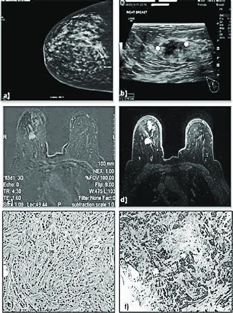 a Mammography: both breasts are dense; new area of slight distortion... | Download Scientific ...