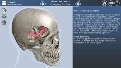 Pterional Craniotomy by UpSurgeOn