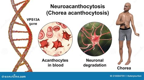 Neuroacanthocytosis, or Chorea Acanthocytosis, a Neurodegenerative ...