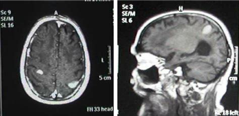 Brain MRI with and without contrast agent on third day | Download Scientific Diagram