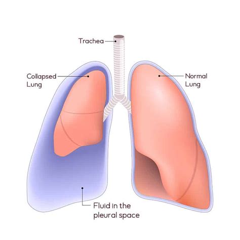 Pleural Effusion Treatment in Singapore - Dr Aneez | Thoracic Doctor