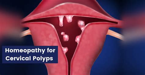 Cervical Polyps - Symptoms, Causes & Homeopathic Remedies