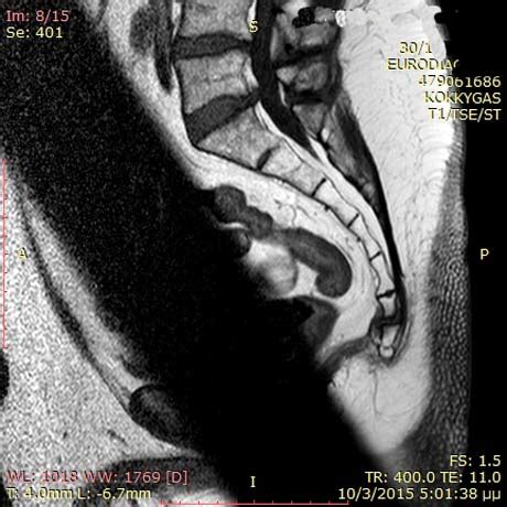 TAILBONE INJURY - COCCYX PAIN - COCCYDYNIA | GEORGE D. GOUDELIS MD. Ph.D.