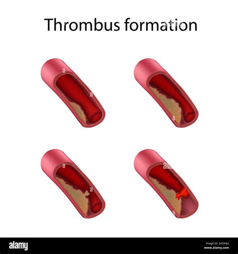 Thrombus formation, illustration Stock Photo - Alamy