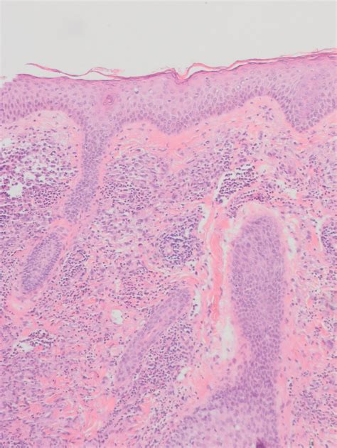 Granuloma Faciale in Woman With Levamisole-Induced Vasculitis | MDedge ...