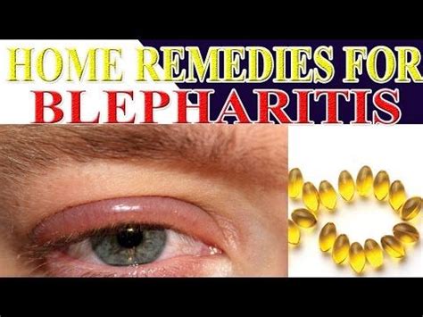 Blepharitis - Home Remedies for Blepharitis - YouTube | Home remedies, Youtube, Blepharitis