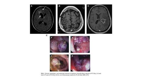 Chronic mucocutaneous candidiasis