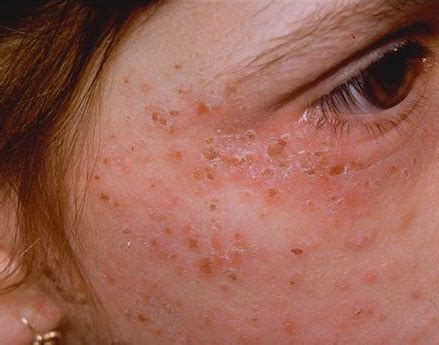 Facts About Porphyria Diverse Disease - Herbs Solutions By Nature