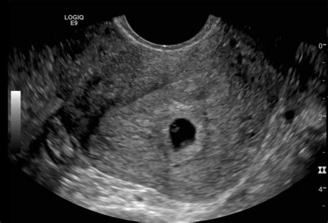 5 Week Ultrasound Scan