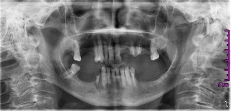 Orthopantomography dated March 2014. | Download Scientific Diagram