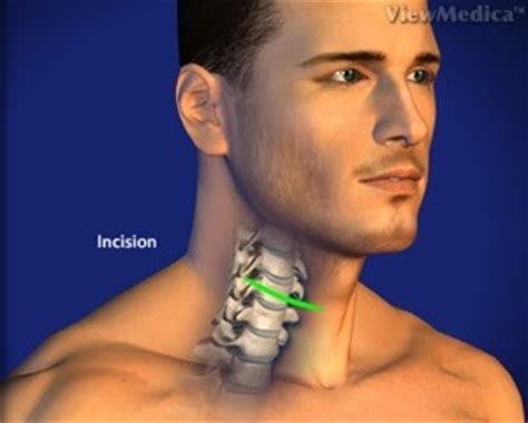 Cervical Corpectomy - Seattle, WA - Spine and Spine Surgery