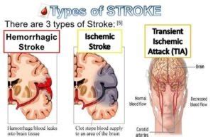 Causes and Types of Cerebrovascular Accidents - HOMEWORK HELP