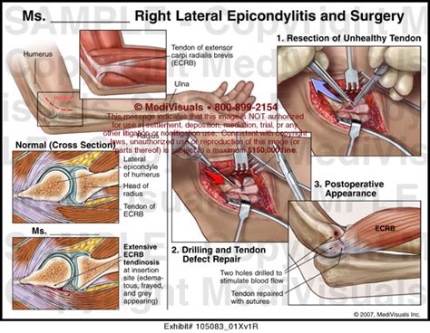 Medivisuals Right Lateral Epicondylitis and Surgery Medical Illustration