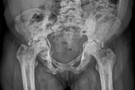 Orthopaedic clinic - avascular necrosis of the hip in adults - Pulse Today