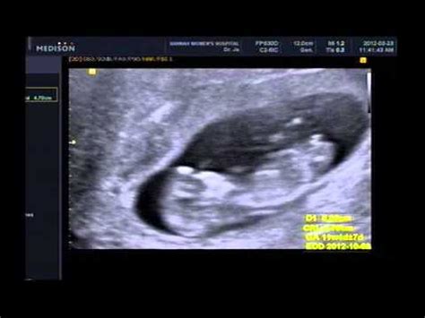 ultrasound pregnancy 3 months baby Ahjin - YouTube