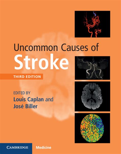 Causes Of Stroke Chart