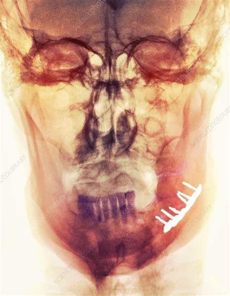 Pinned broken jaw, X-ray - Stock Image - M330/1551 - Science Photo Library