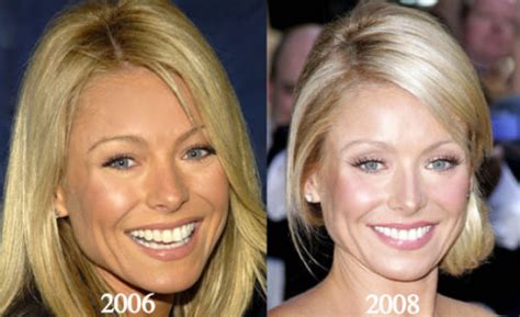 Kelly Ripa Plastic Surgery Before and After Photos - Latest Plastic ...