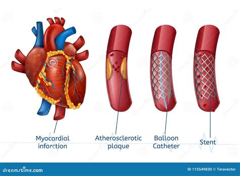 Heart Attack Myocardial Infarction