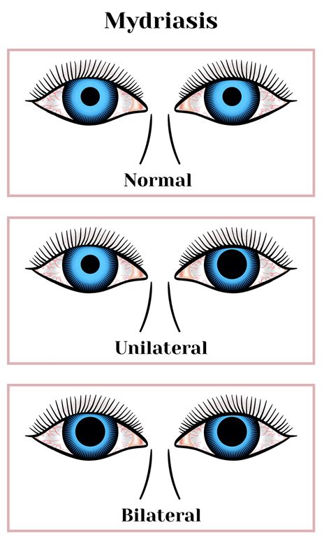 Dilated Pupils: Causes, Risks & Treatments