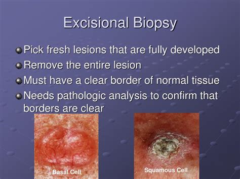 PPT - Biopsy Techniques PowerPoint Presentation, free download - ID:6574308