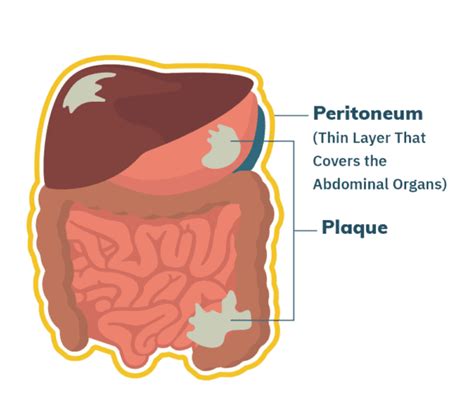 Malignant Mesothelioma Cancer | Stages, Prognosis, Treatment