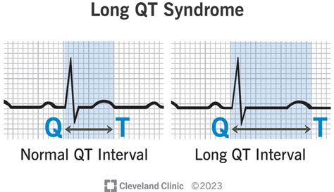 Long QT Syndrome: Symptoms & Treatment - Chia Sẻ Kiến Thức Điện Máy ...