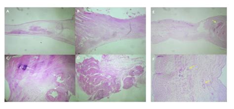 Histologic description of the aortic valve of both cases Case 1. Aortic ...