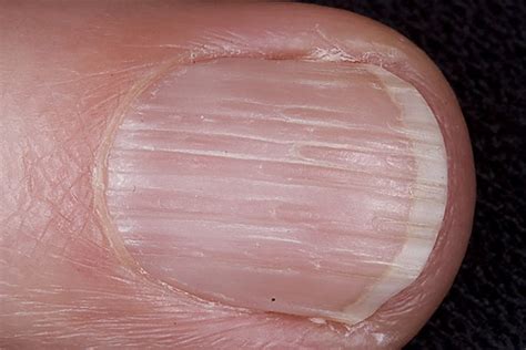 Vertical Lines On Fingernails Deficiency