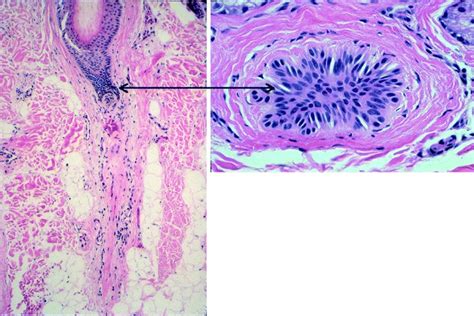 Telogen hair: In vertical section, the telogen club with its sac of... | Download Scientific Diagram