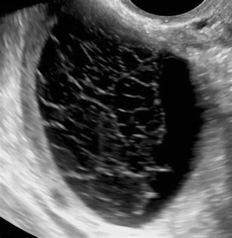 Hemorrhagic Cyst. Ultrasound image of a hemorrhagic cyst shows... | Download Scientific Diagram