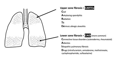 Pulmonary fibrosis | OSCEstop | OSCE Learning