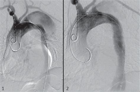 1: Intraoperative aortography demonstrating Stanford type B aortic... | Download High-Resolution ...