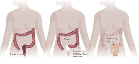 Treatments - Surgery - Digestive Cancers Europe