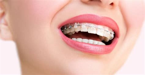 How Long Do You Have To Wear A Retainer After Invisalign / How Long Do ...