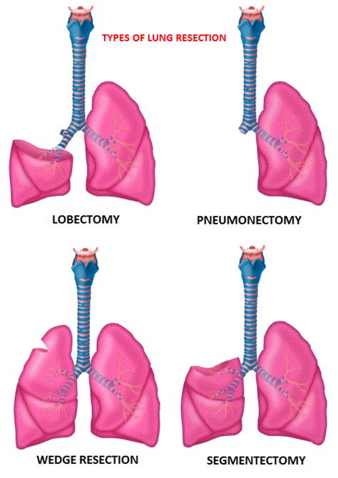 Lobectomy Superior to Sublobar Resection in Early Stage Non Small Cell Lung Cancer – OncoPrescribe