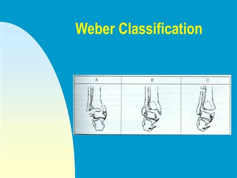 PPT - ANKLE FRACTURES PowerPoint Presentation, free download - ID:3603223