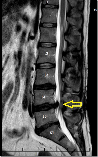 l5 normal mri | Degenerative disc, Degenerative disc disease, Mri